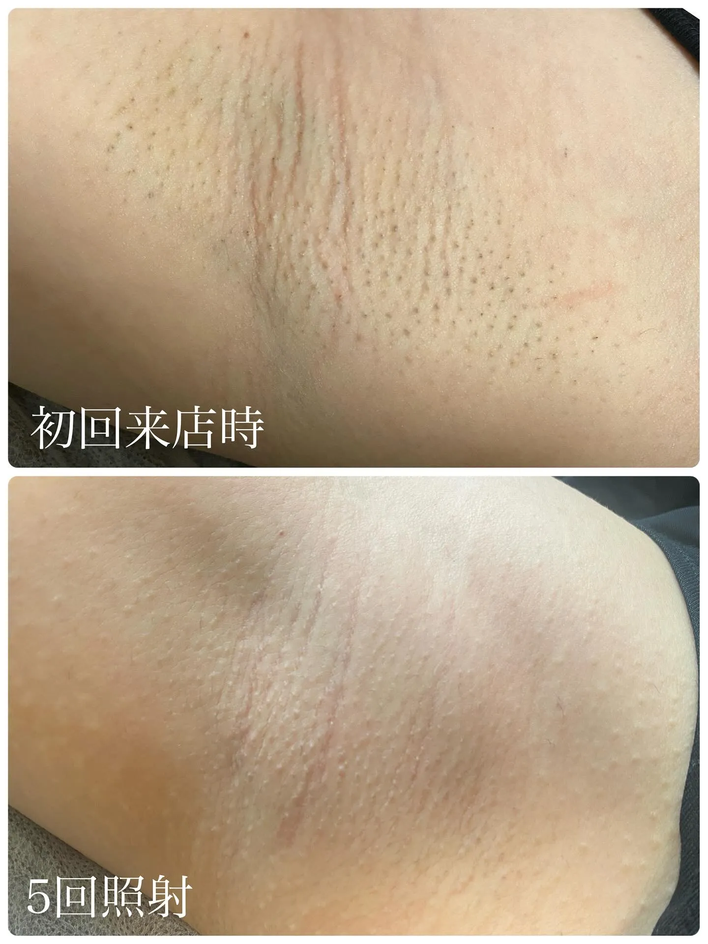 【脇脱毛の嬉しい変化🌿】