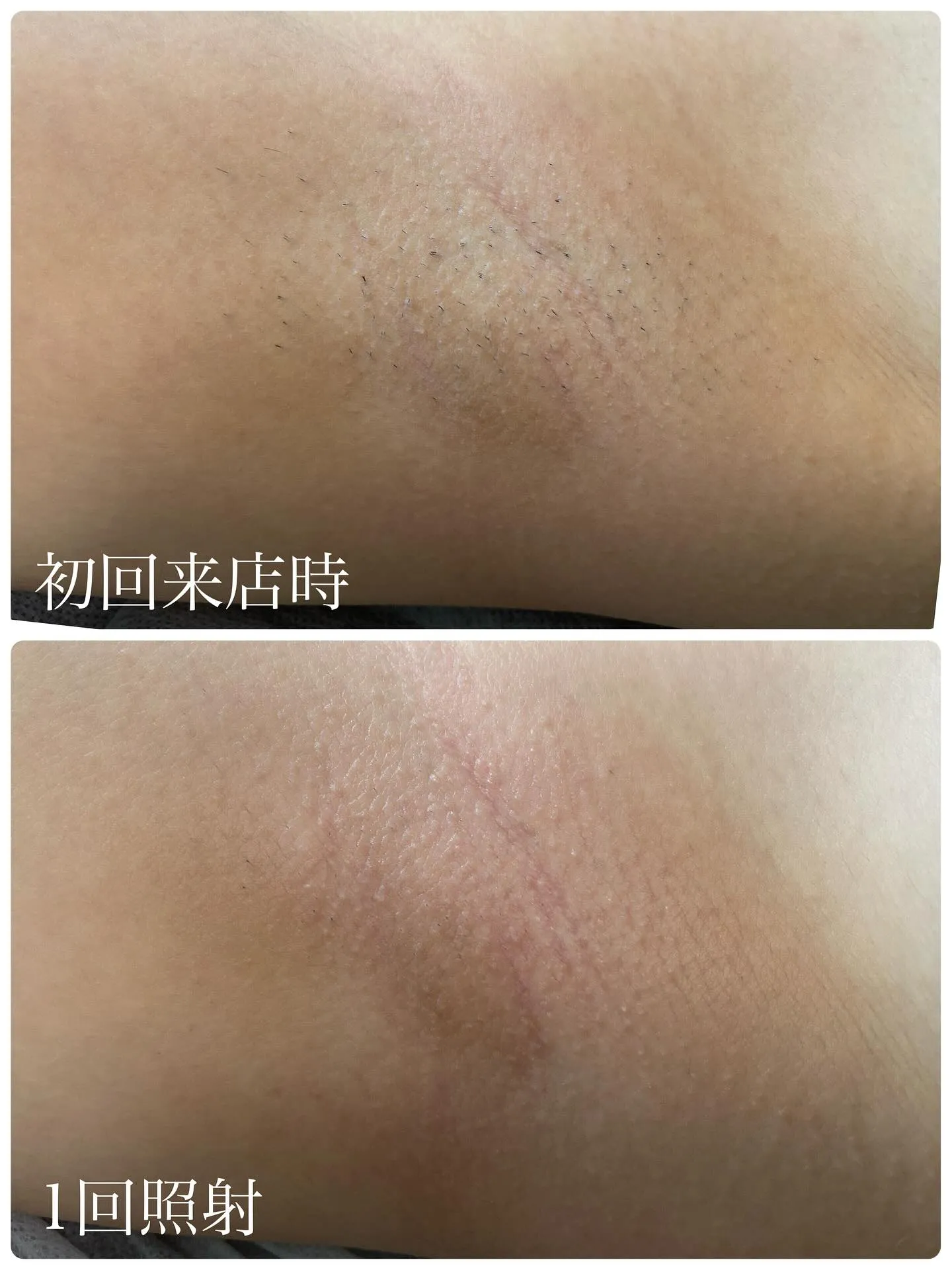 【脇脱毛は効果が出るのが早い✨】